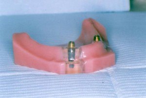 Doylestown Dentist Implant Doylestown Dentist Implant