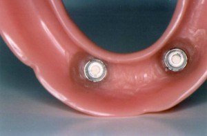 Doylestown Dentist Implant 2 Doylestown Dentist Implant 2