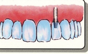 Doylestown Dentist Implant 3 Doylestown Dentist Implant 3